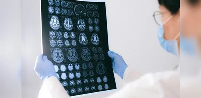 Exame de sangue combinado a teste genético estima risco de Alzheimer
