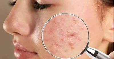 Acne exige cuidados que vão além do controle da oleosidade