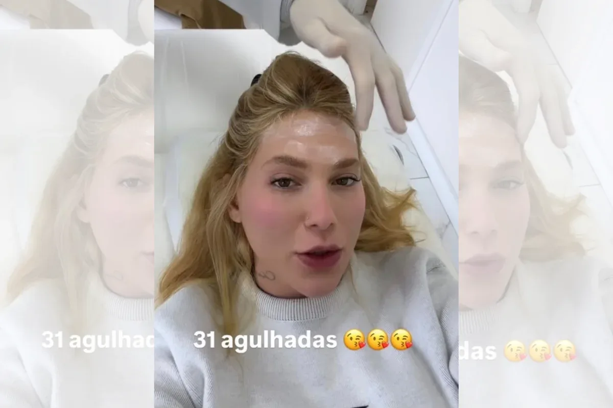 Virginia Fonseca retoma botox para controlar crises de enxaqueca