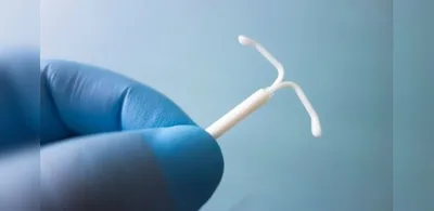 ANS inclui DIU hormonal na cobertura obrigatória para casos de endometriose