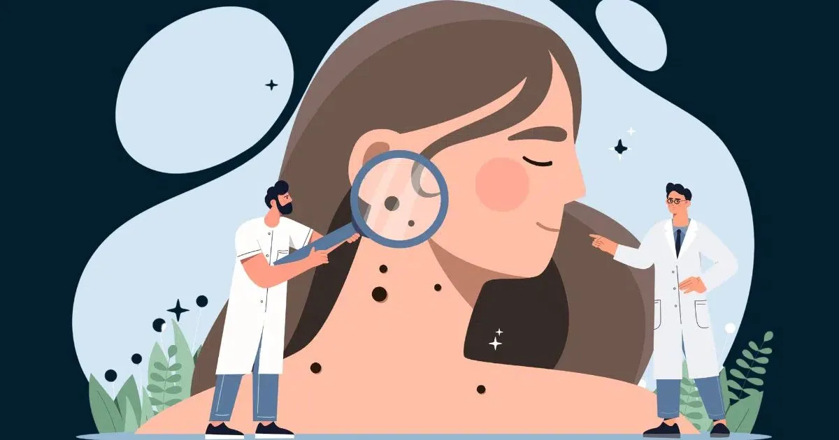 Cirurgia de Mohs analisa o tumor durante o procedimento e pode chegar a 99% de cura